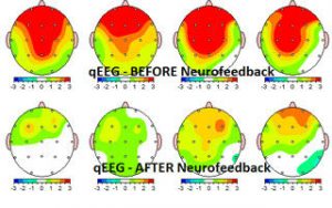 Neurofeedback, Neurofeedback for ADHD