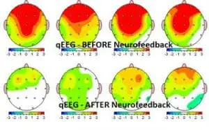 brainmaps | Sachs Center | Autism ADHD Testing and Treatment